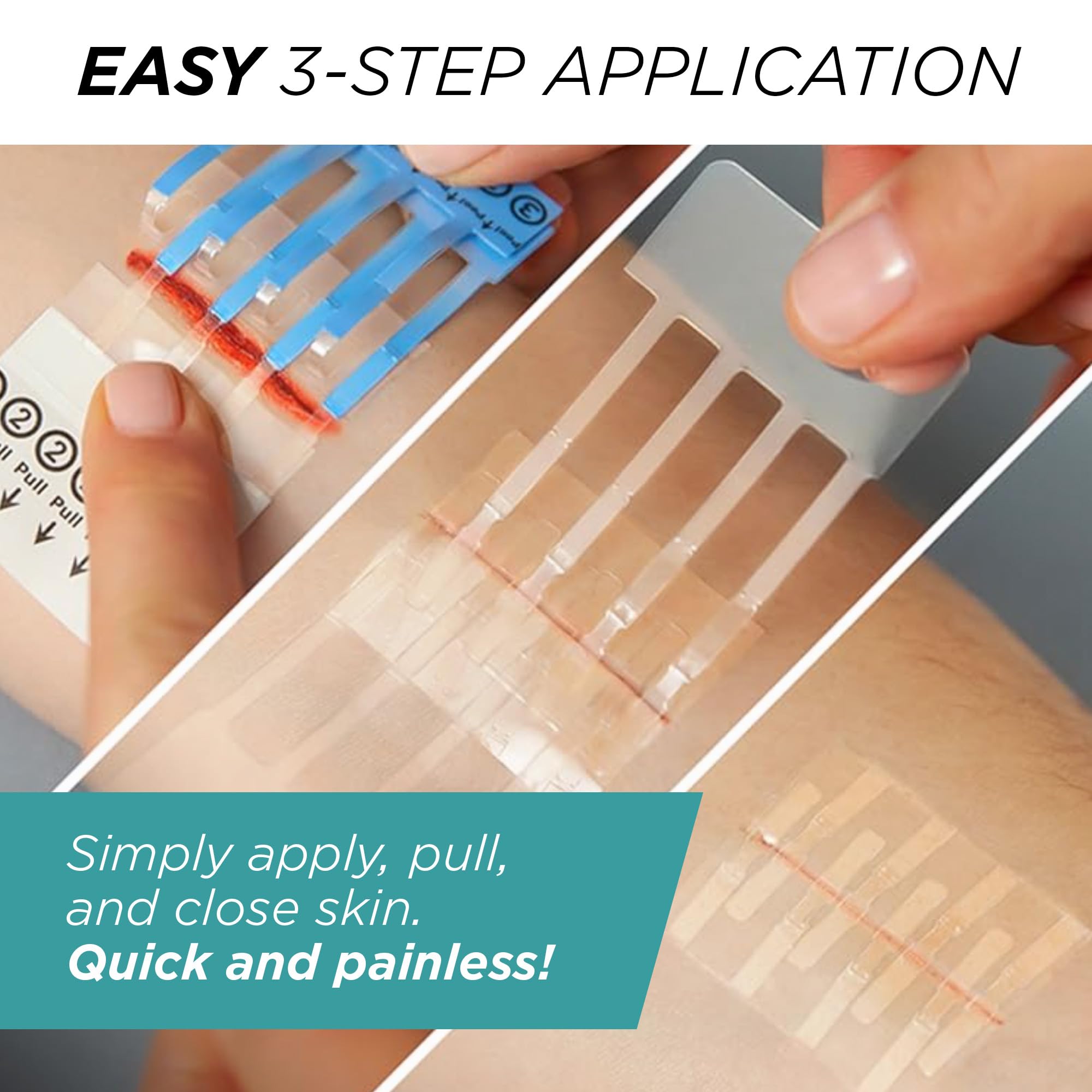 Clozex interlaced design emphasizes precise wound edge alignment