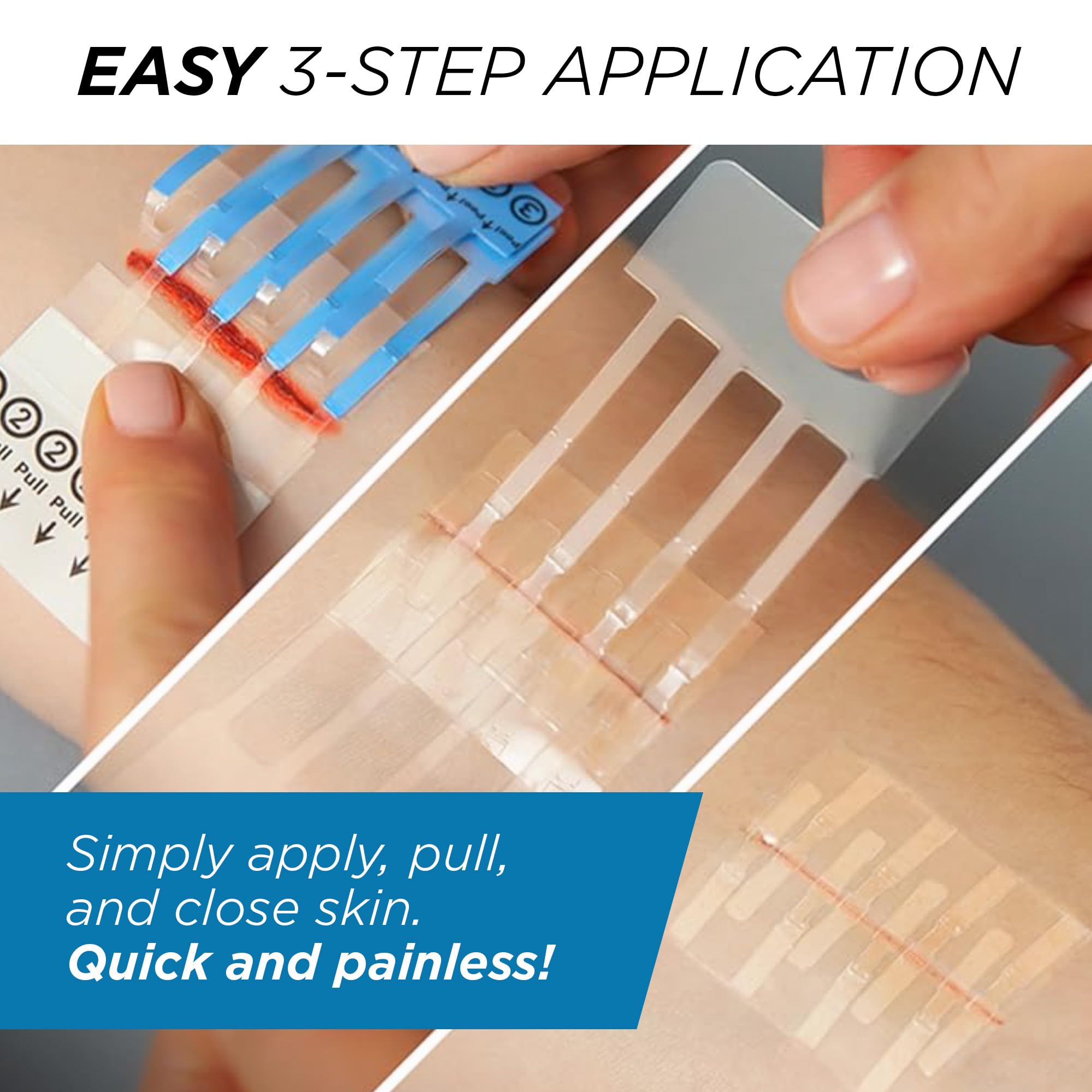 Clozex kit supports two wounds or longer closure length.