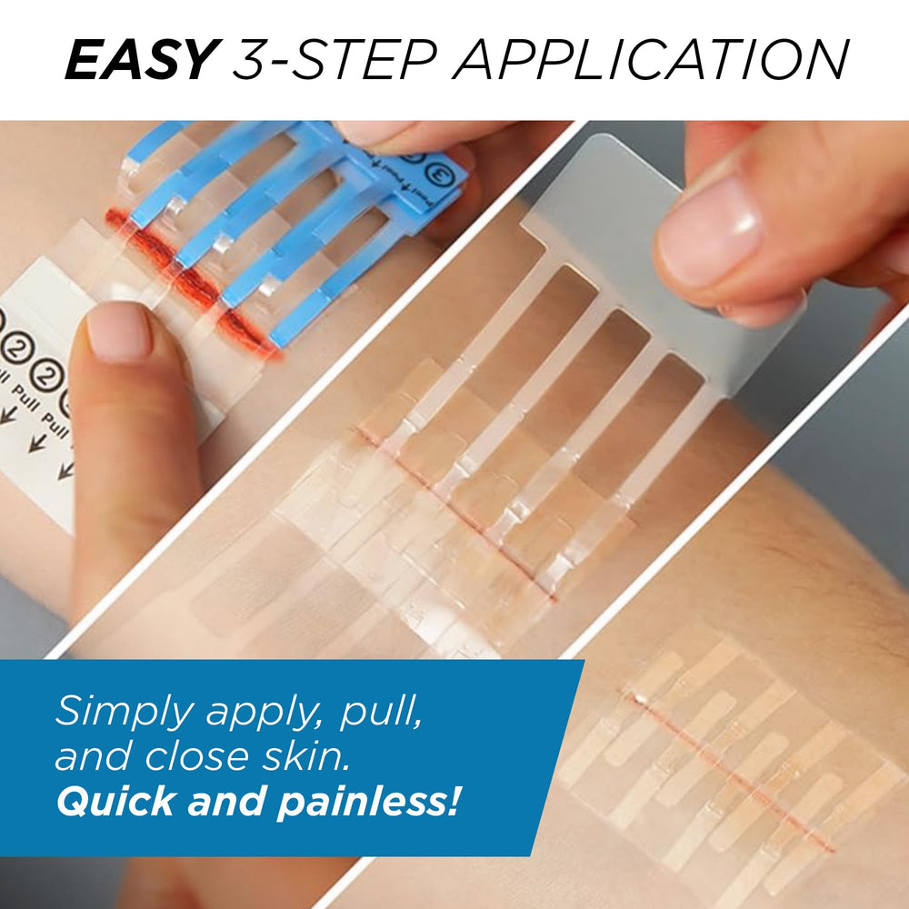 Clozex kit supports two wounds or longer closure length.