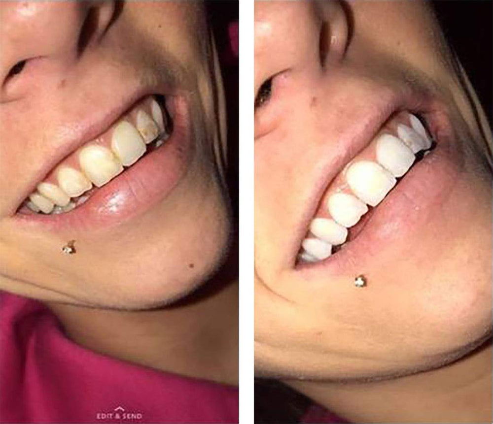 COLO Color Wheel Teeth Whitener Mint gel swirl used in quick at-home whitening sessions
