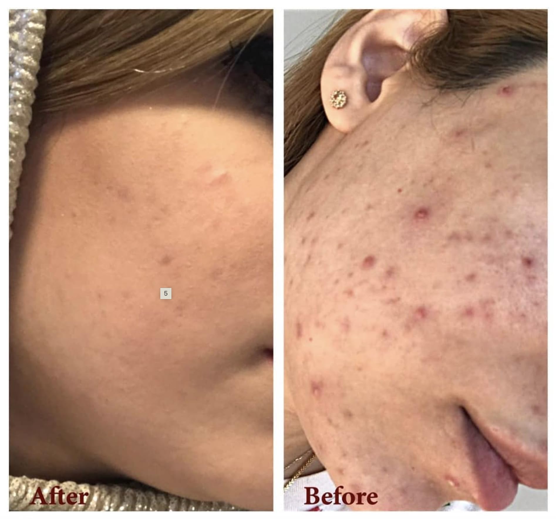Demodexcillin skin solution showing potential redness relief and calm.