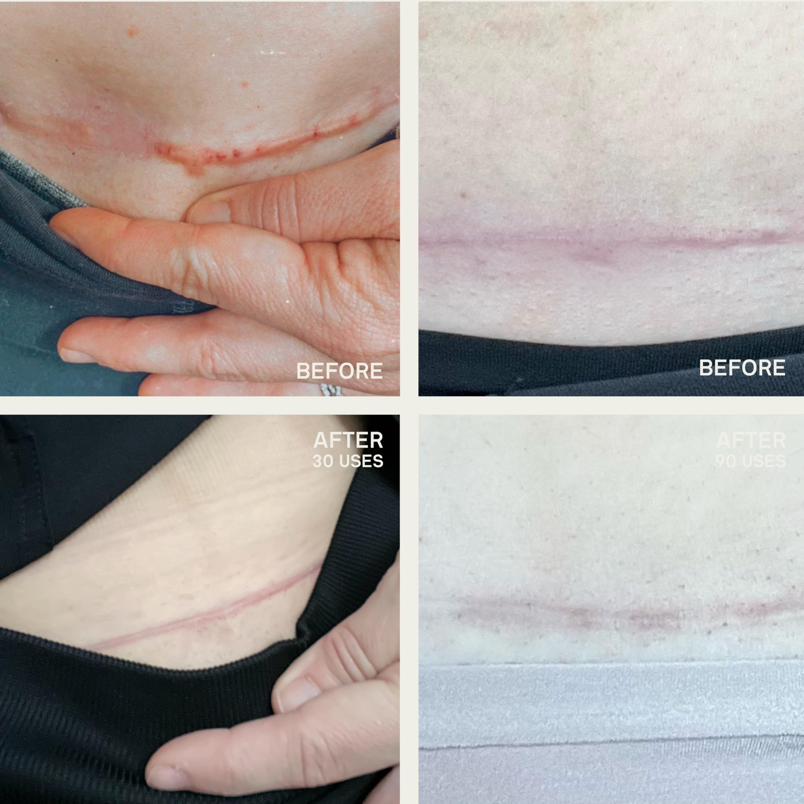 Dermaclara stretch-mark prevention patch demonstrating skin elasticity support