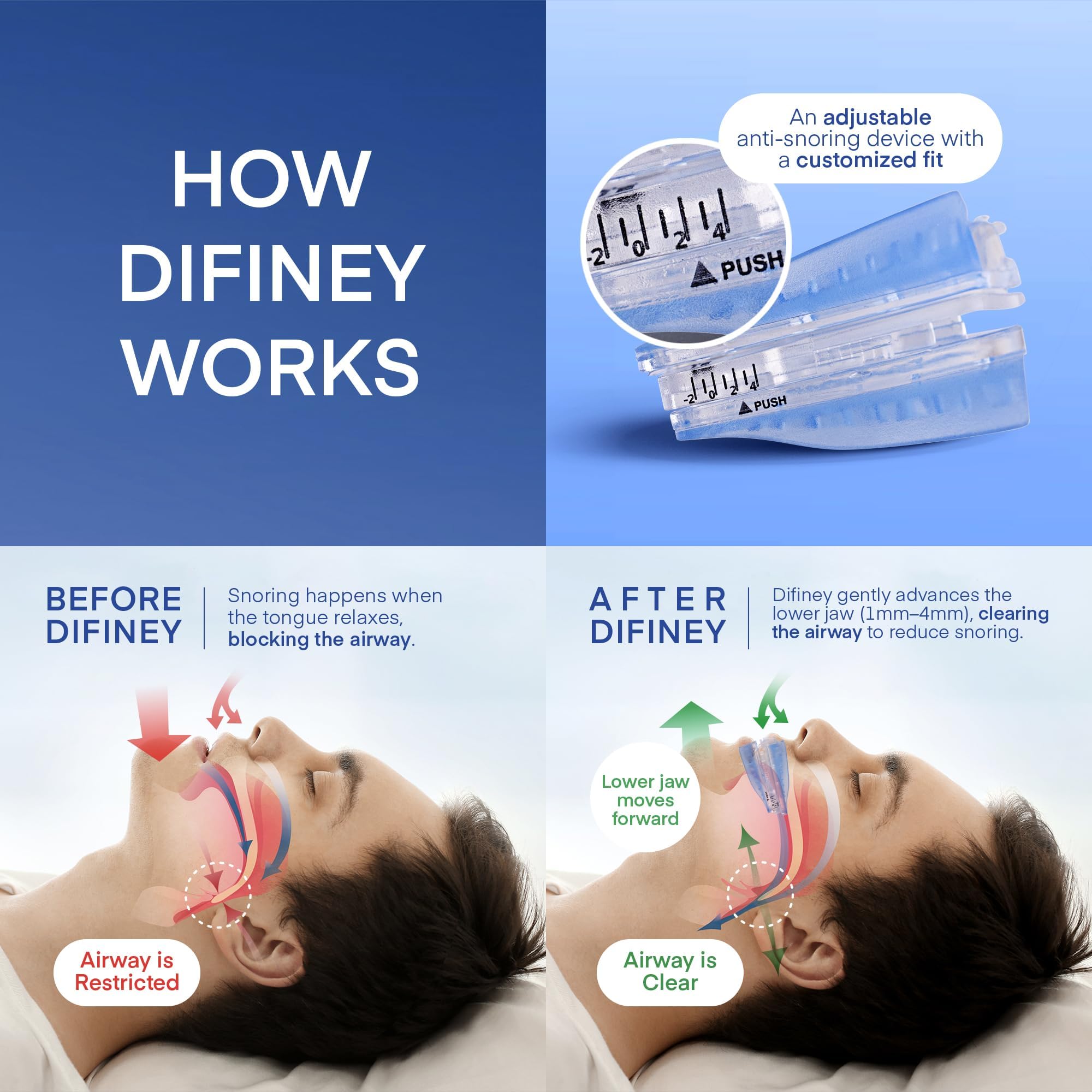 Difiney Anti Snoring Device jaw-repositioning helps open airways for quieter sleep.