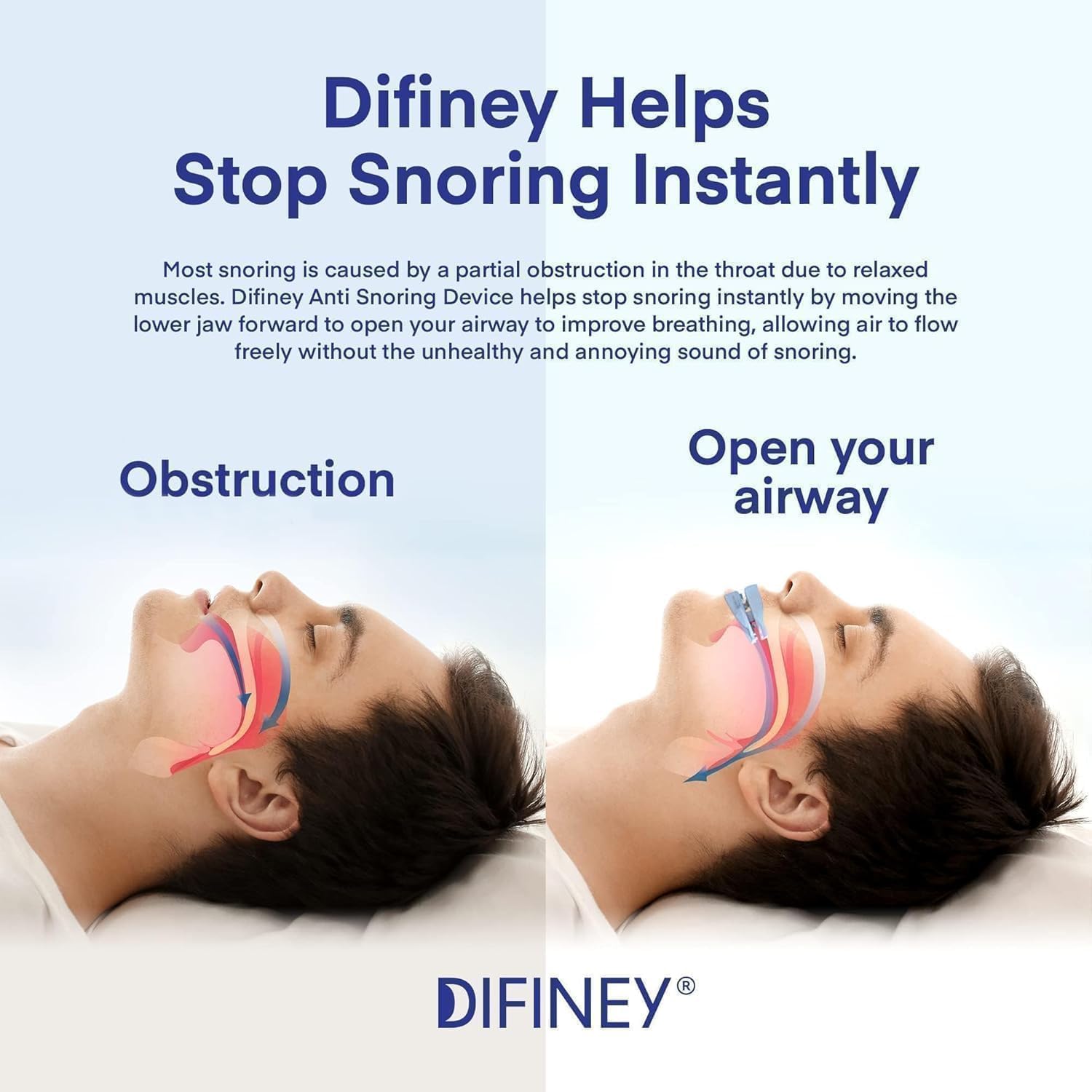 Difiney anti-snoring device side profile highlights compact, travel-friendly design