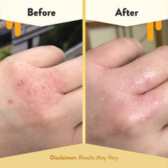 ECZEMA HONEY cream texture on skin suggests smooth daily use