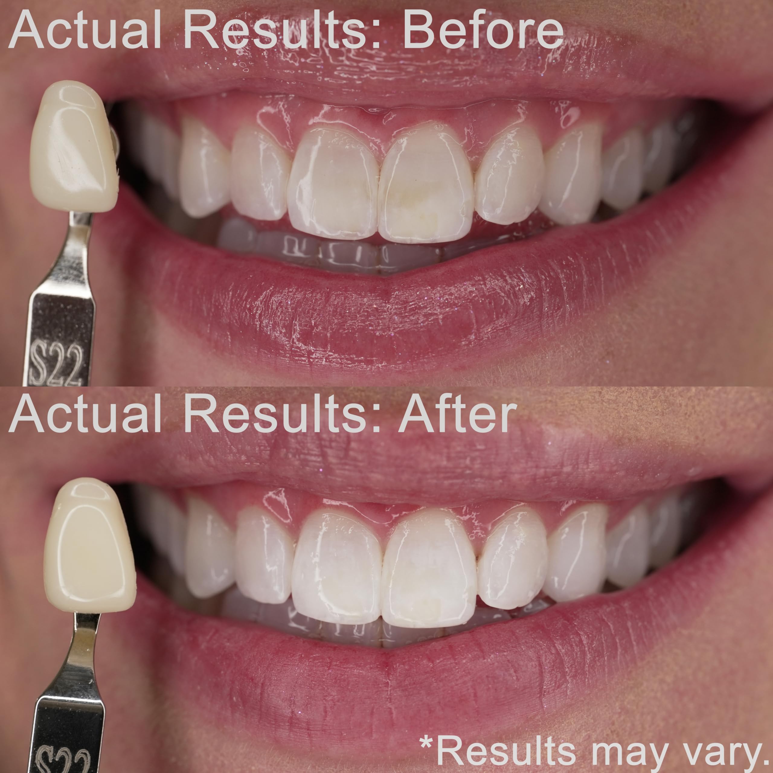EZZI 3mL syringes ready for application on teeth for gentle whitening.