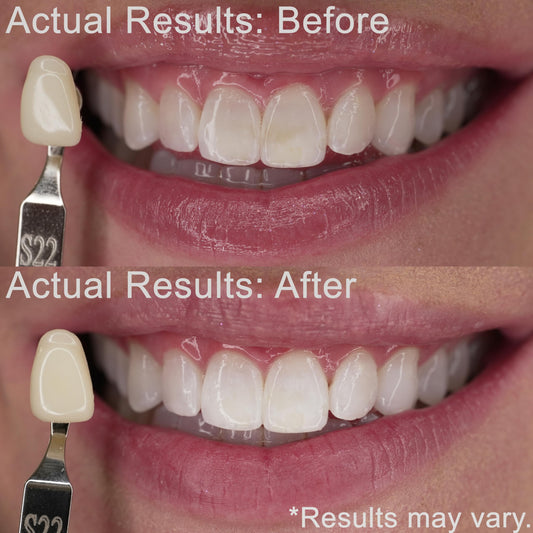 EZZI 3mL syringes ready for application on teeth for gentle whitening.