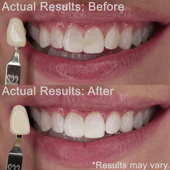 EZZI 3mL syringes ready for application on teeth for gentle whitening.