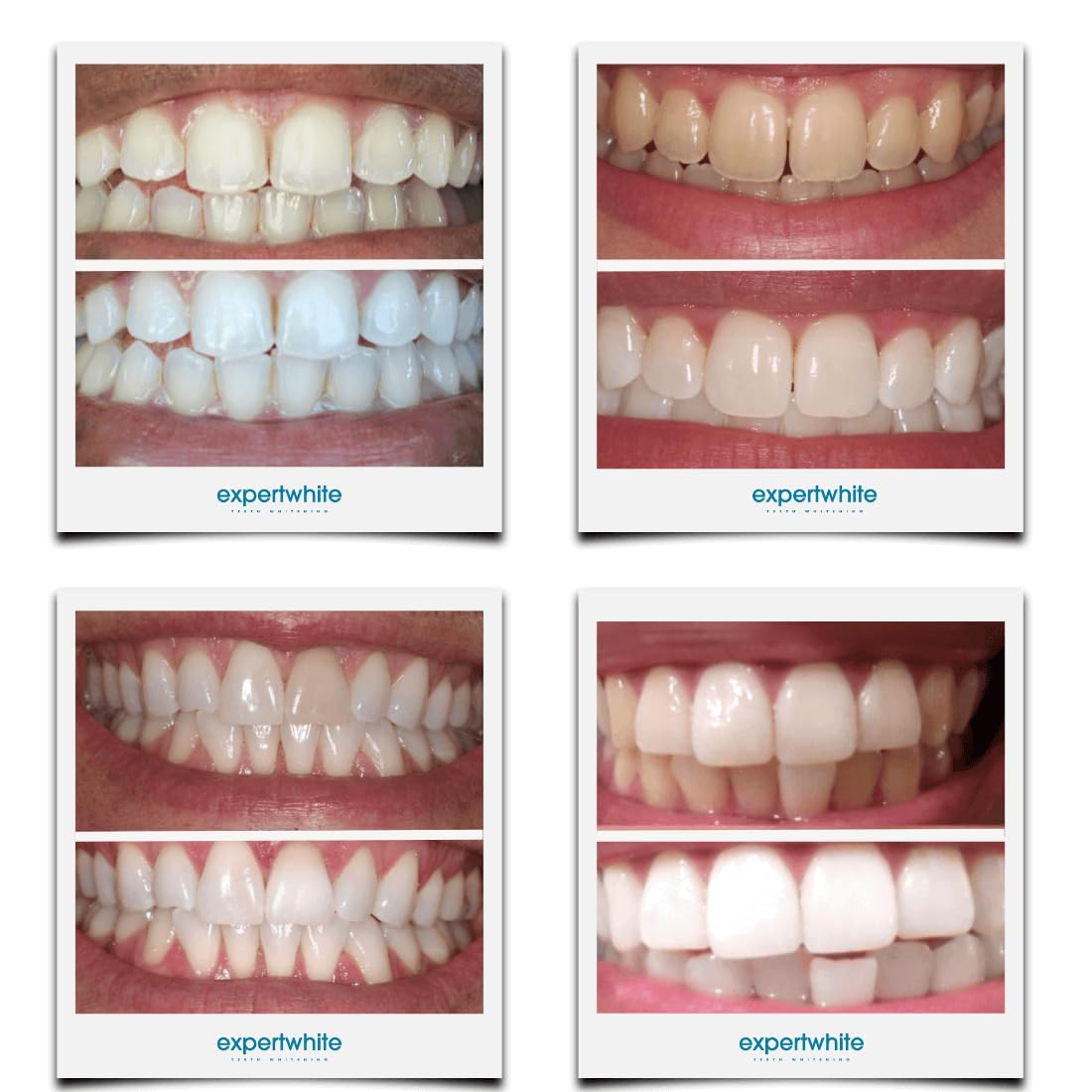 15-minute whitening session setup with Expertwhite gel and trays in progress.