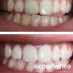 Close-up of Expertwhite 3cc syringe for accurate dosing.