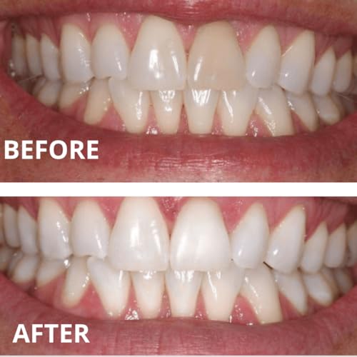 Invisalign-style trays compatible with Expertwhite whitening gel.
