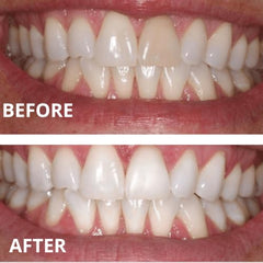 Invisalign-style trays compatible with Expertwhite whitening gel.