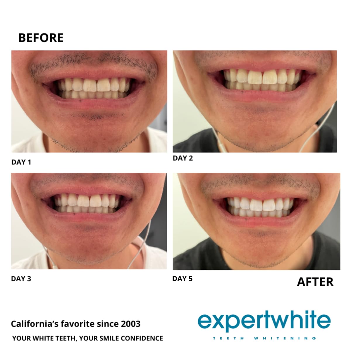 Accurate measurement reduces waste and keeps whitening on track.