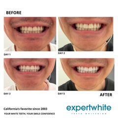 Accurate measurement reduces waste and keeps whitening on track.
