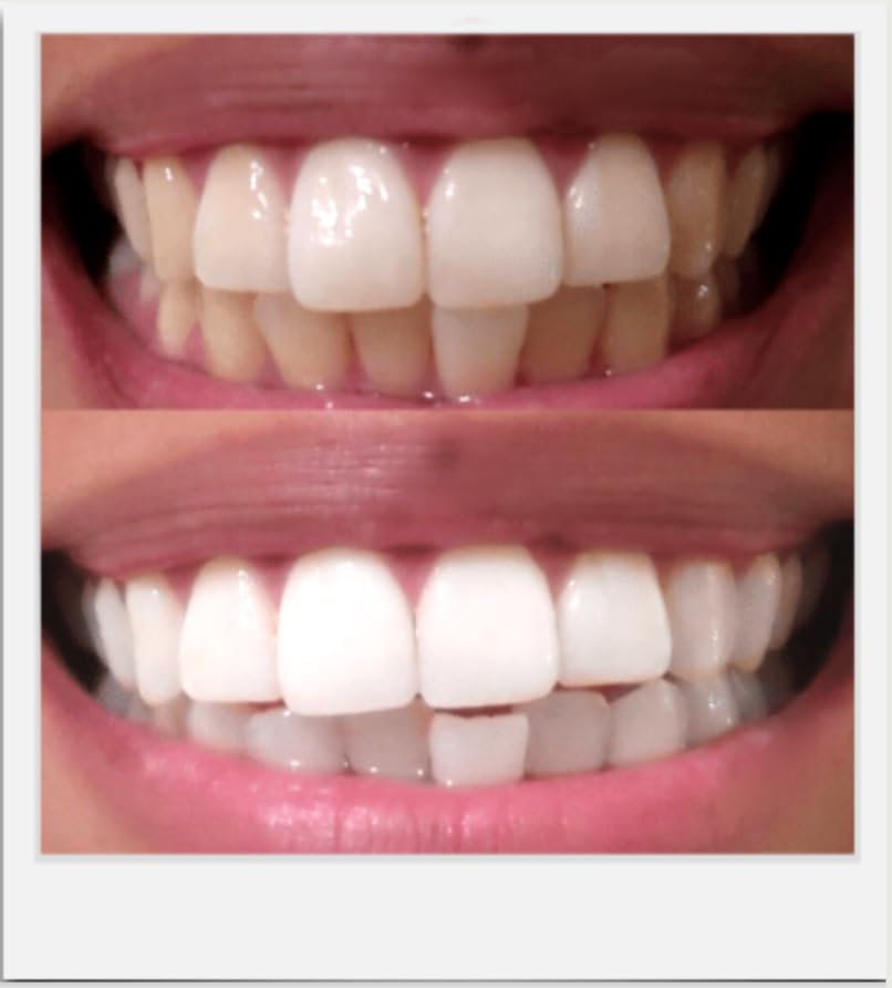 Deep stain removal from coffee, wine, and tea with Expertwhite gel.