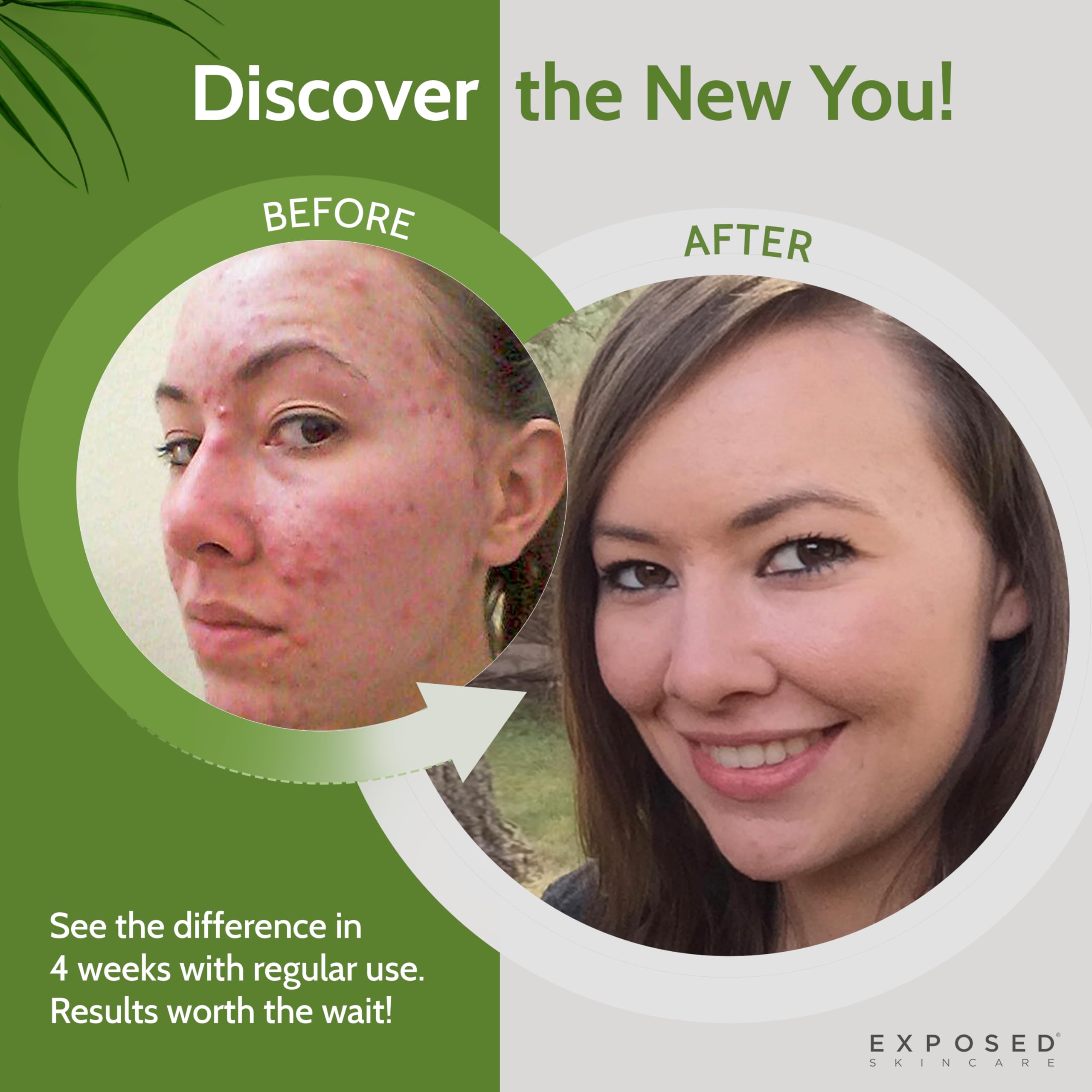exposed skin care probiotic bottle glow implies potential for clearer balanced skin