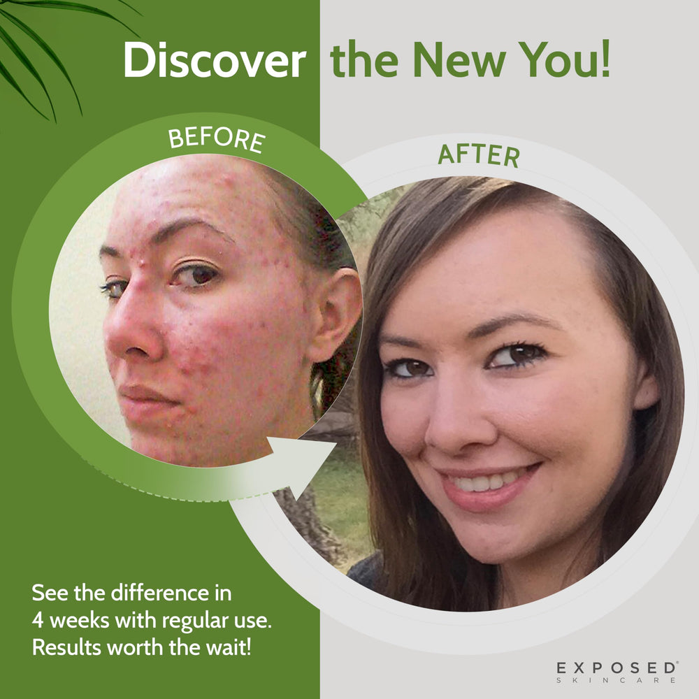 exposed skin care probiotic bottle glow implies potential for clearer balanced skin