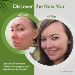 exposed skin care probiotic bottle glow implies potential for clearer balanced skin