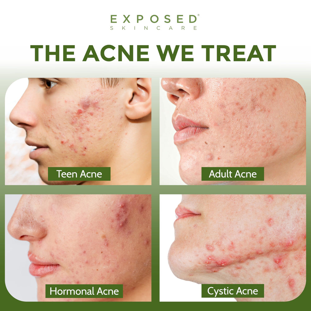 exposed skin care probiotic capsules pour demonstrates easy daily use for gut and skin wellness