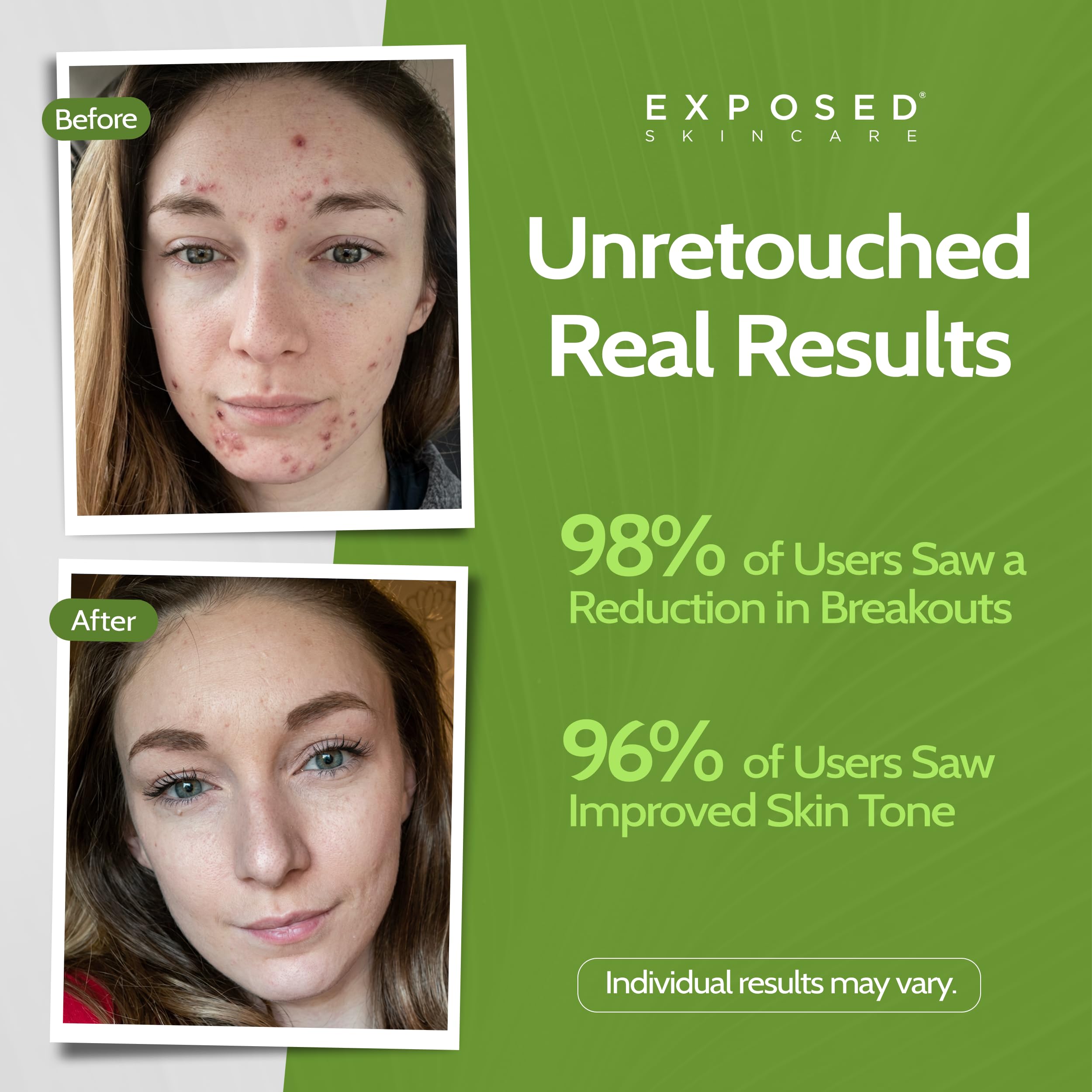 exposed skin care probiotic label closeup showcases vegan non-gmo formulation and skin benefits
