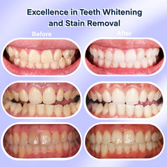 Fabulshine LED light on stand during a whitening session.