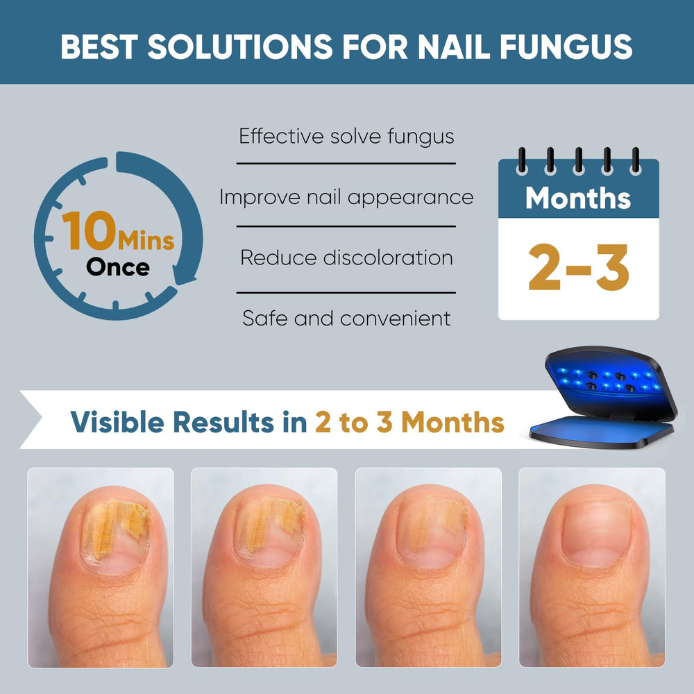 FEIGOMA Nail Fungus Light Device is applied to toenails for healthy appearance.