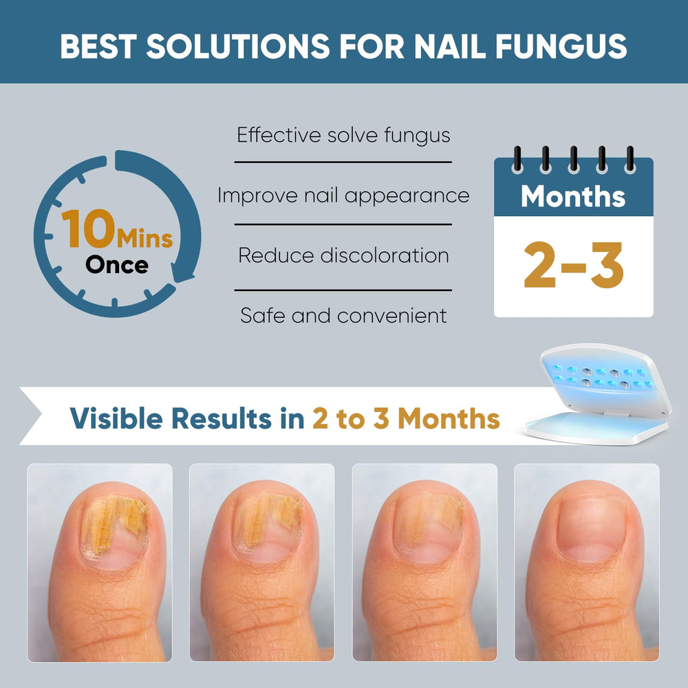 FEIGOMA Nail Fungus Light Device hand in use for targeted at-home treatment