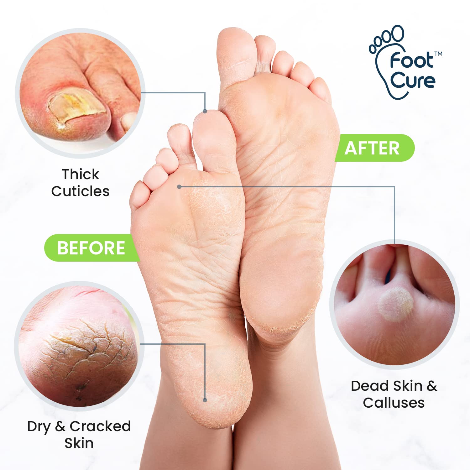 FOOT CURE toenail softener kit enables easy at-home maintenance