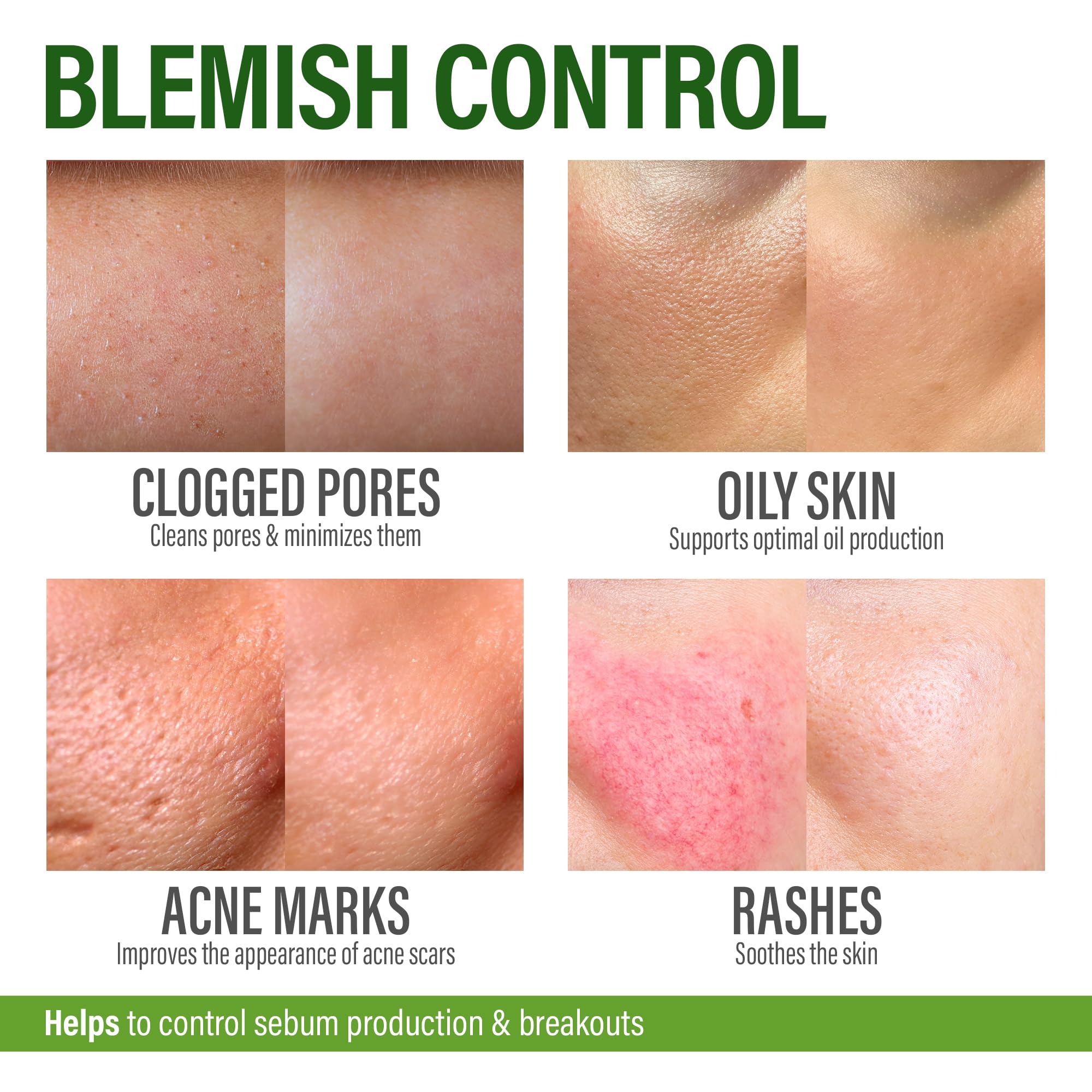 Zinc and Vitamin A formula close up suggesting balanced sebum and even tone.