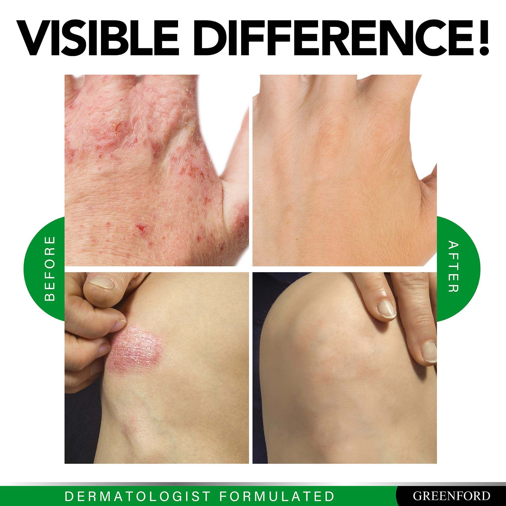 Greenford Eczema Support in use during daily skincare routine