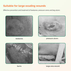 Greetmed ready-to-use Sacrum Foam Dressing in sterile packaging for convenient care.