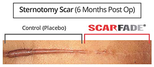Hanson Skincare silicone scar ointment being applied to skin demonstrates soft, non-greasy layer.