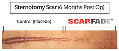 Hanson Skincare silicone scar ointment being applied to skin demonstrates soft, non-greasy layer.