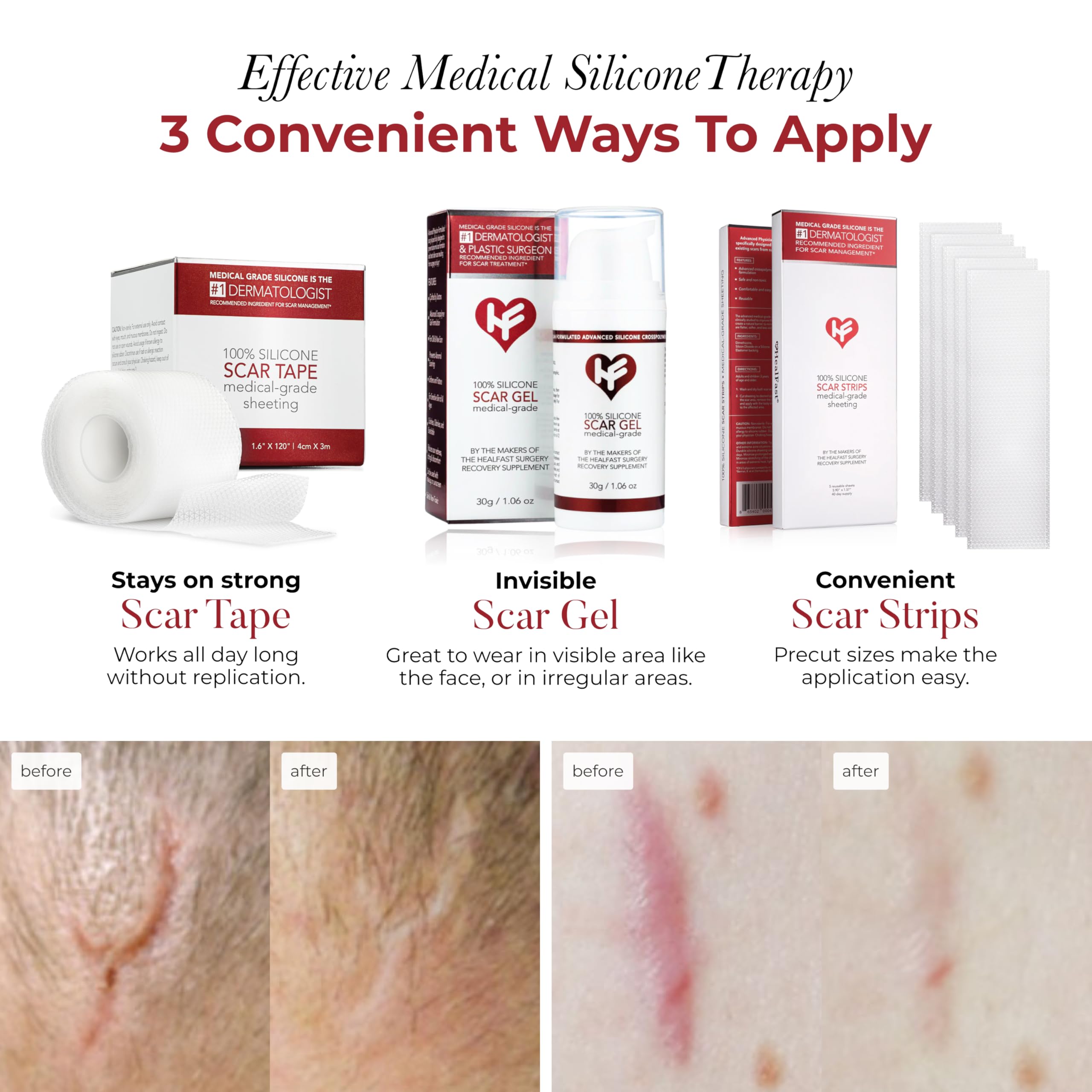 HealFast silicone scar sheets on skin application for discreet, flexible coverage