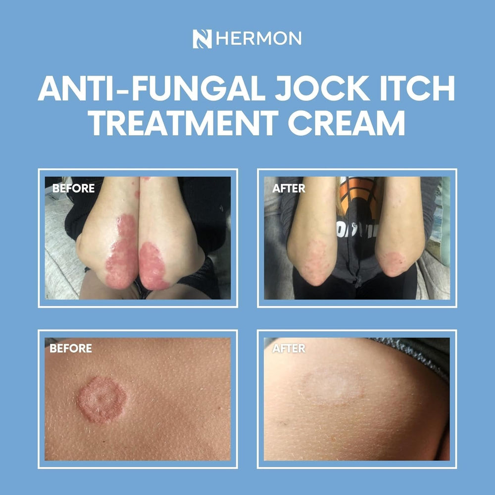 Hermon Jock Itch Cream paraben-free badge and everyday readiness