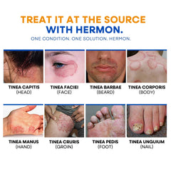 Hermon Ringworm Kit-all-ages: safe for adults and kids when used as directed
