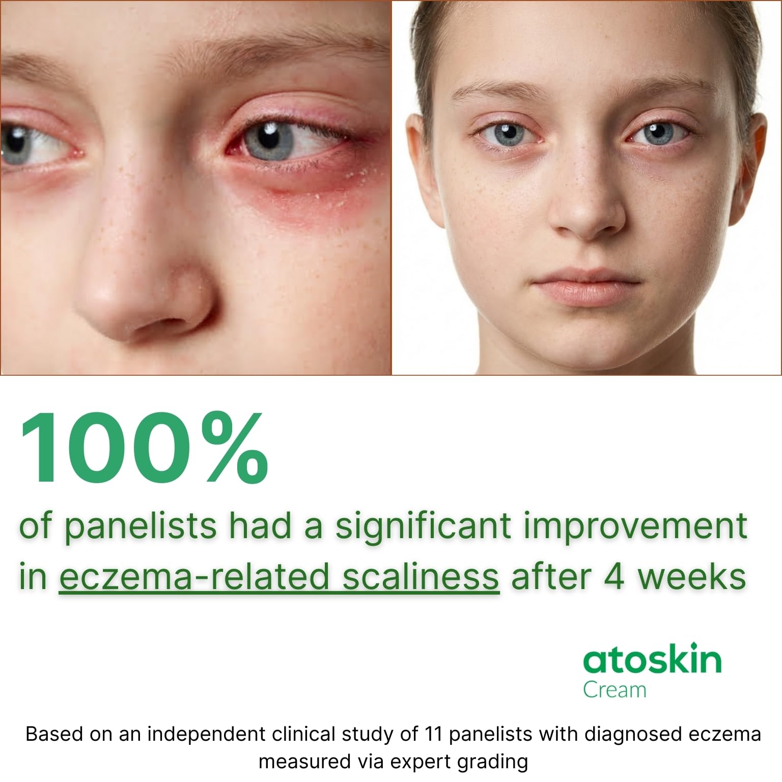 HVSun Atoskin Cream suitable for kids and adults seeking gentle care