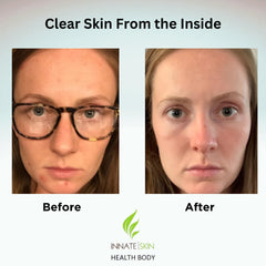 Innate Skin 60-count pack front — value for a consistent acne vitamin routine