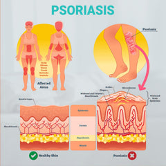 Ishancare Psoriasis Cream ingredients close-up highlighting colloidal oatmeal and botanicals