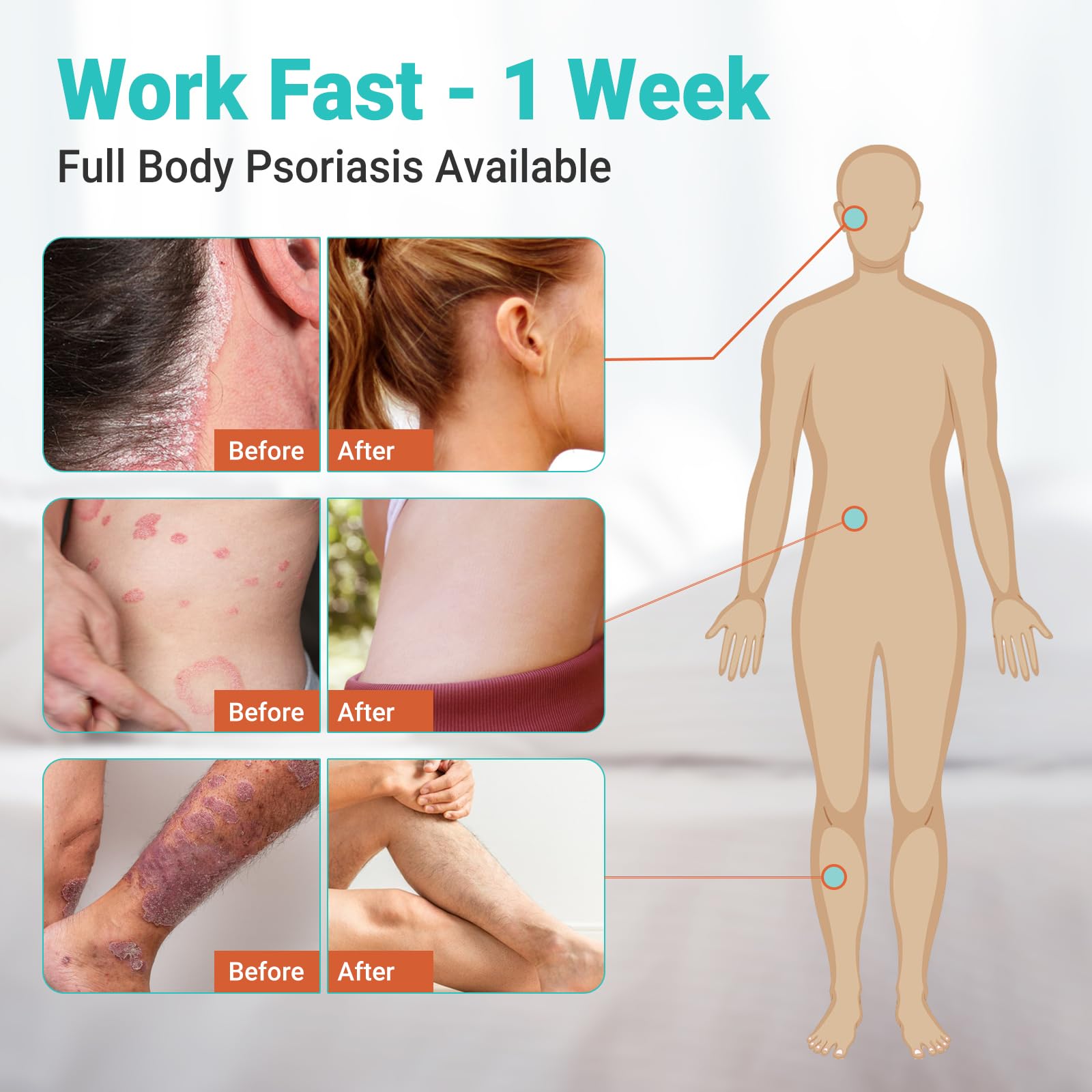 Ishancare Psoriasis Cream on skin demonstrates gentle hydration without greasiness