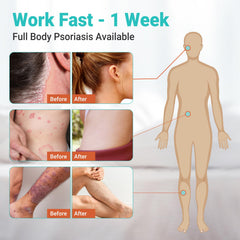 Ishancare Psoriasis Cream on skin demonstrates gentle hydration without greasiness