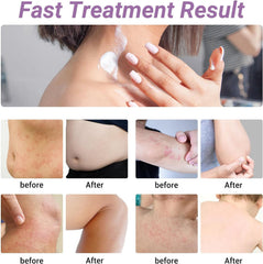 Ishancare Urticaria Cream label close-up reinforces clean, all-natural branding.