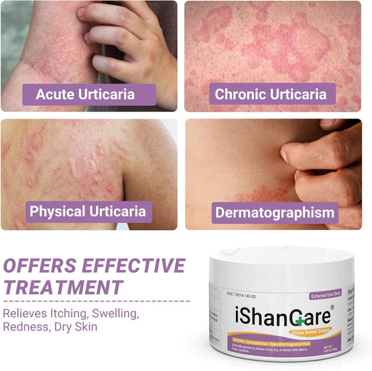 Ishancare Urticaria Cream tube dispensing tip highlights fast acting relief.