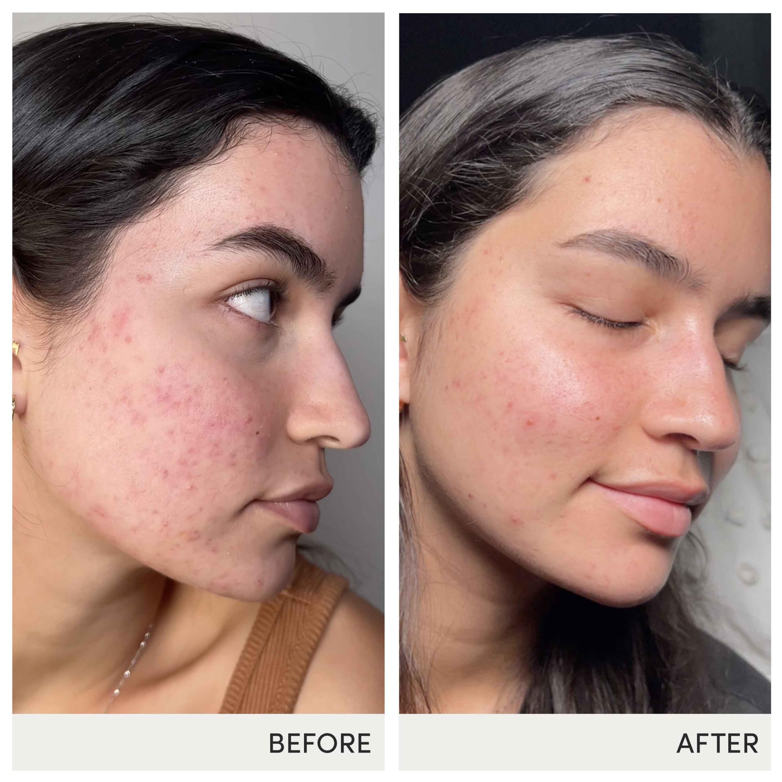 Diindolylmethane (DIM) ingredient highlighted with Skin Accumax vitamins.