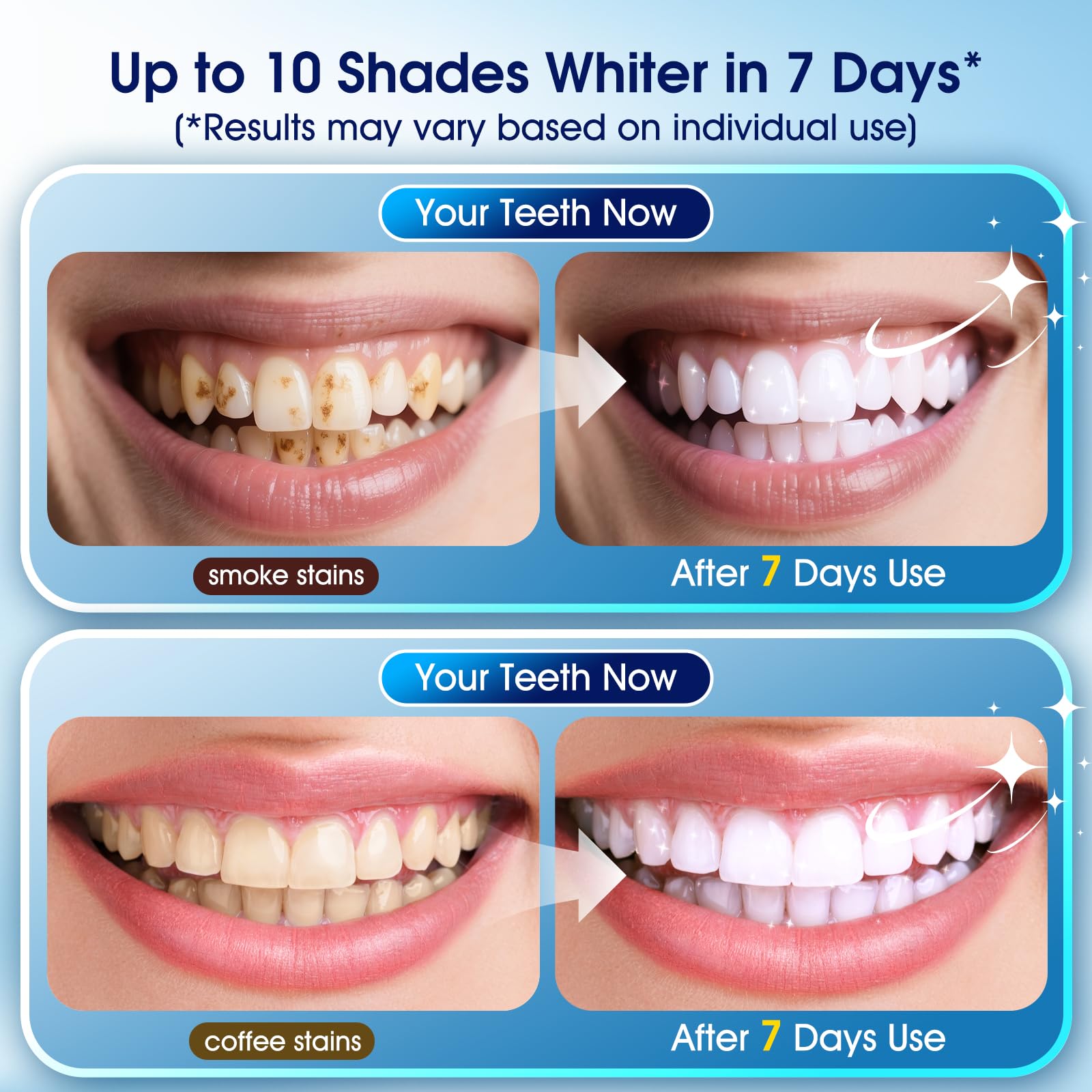 KOAEO LED light activation device used with the whitening gel at home.