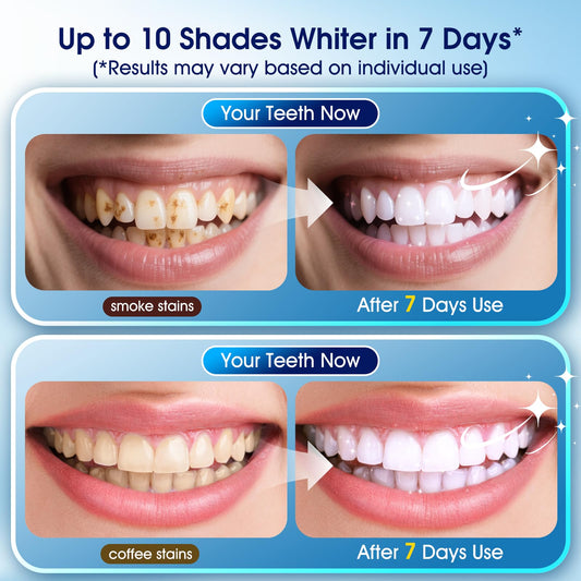 KOAEO LED light activates whitening gel for faster, even results.