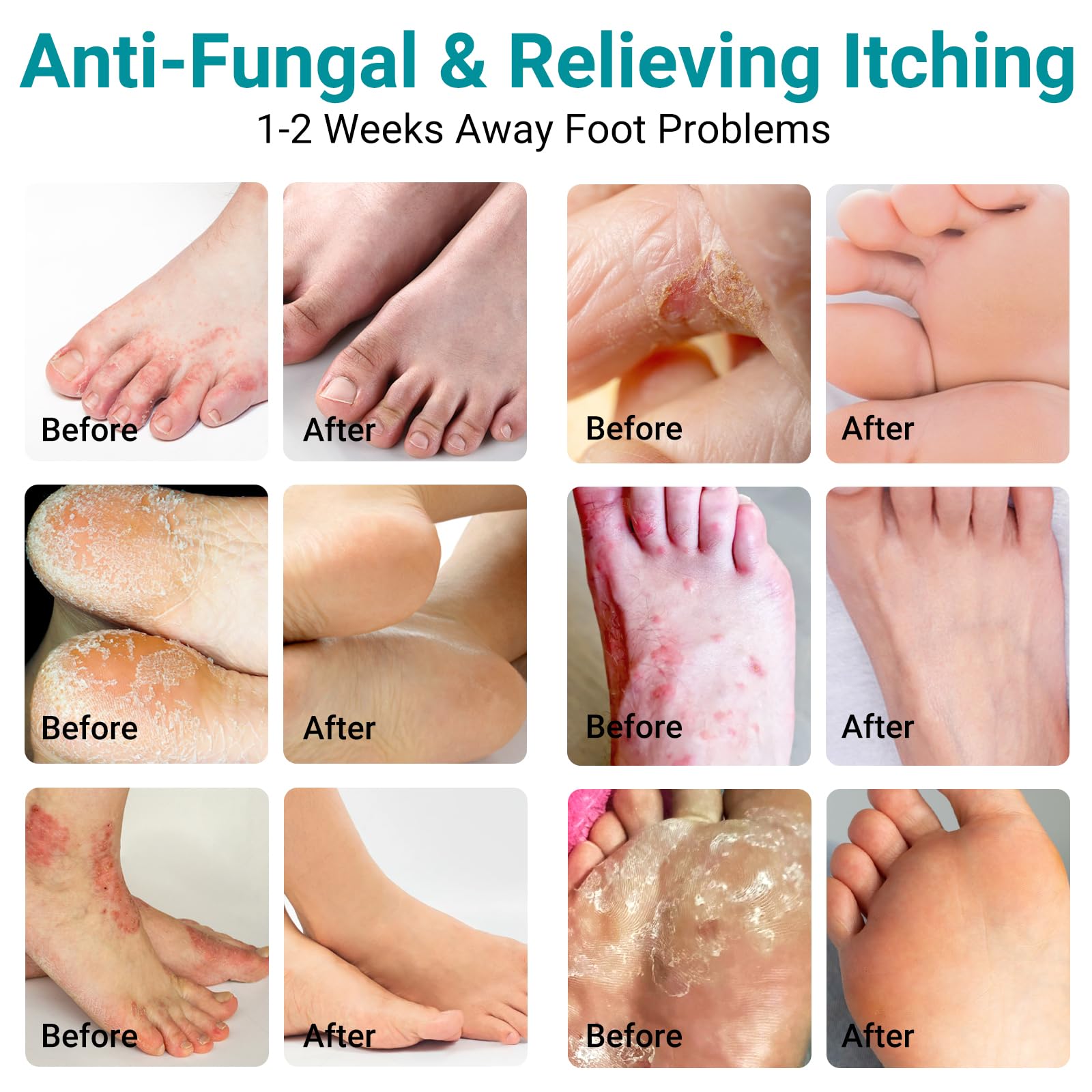Applying LMNOOP Athletes Foot Cream on the foot for relief.
