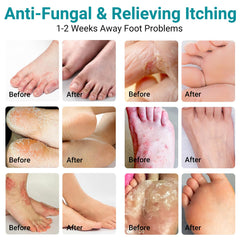 Applying LMNOOP Athletes Foot Cream on the foot for relief.