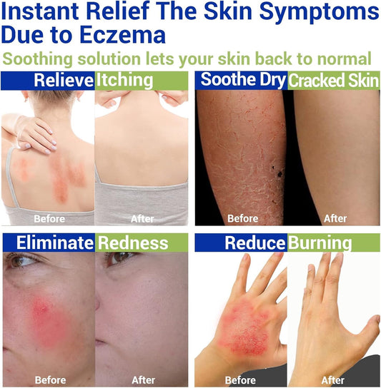 LMNOOP Eczema Cream texture close-up highlighting smooth absorbs quickly