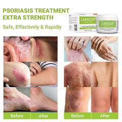 LMNOOP Psoriasis Cream packaging visible for easy application